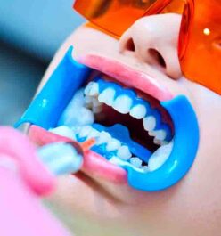 Clareamento Dental 3 {{brizy_dc_image_alt imageSrc=