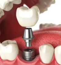 Implantes Dentários em Moema SP pela Clínica da Dra. Fátima Faraco ImplanteDentalemmoemafaraco