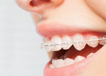 Aparelhos de Porcelana - Faraco {{brizy_dc_image_alt imageSrc=