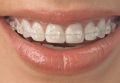 Aparelhos de Safira na Clínica Faraco {{brizy_dc_image_alt imageSrc=