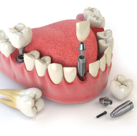 implante-dentario-faraco implante dentario faraco