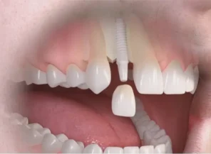 Implantes Dentários em Moema SP pela Clínica da Dra. Fátima Faraco Implantes Dentários em Moema SP pela Clínica da Dra. Fátima Faraco
