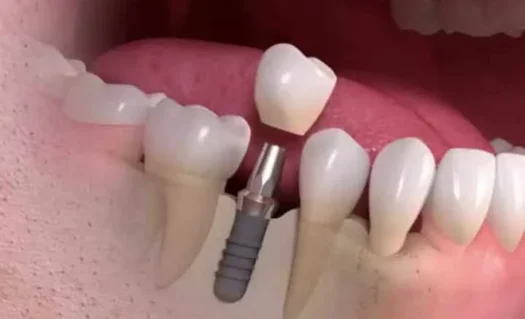 implante_unitario_faraco implante unitario faraco