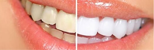 Clareamento Dental 4 {{brizy_dc_image_alt imageSrc=